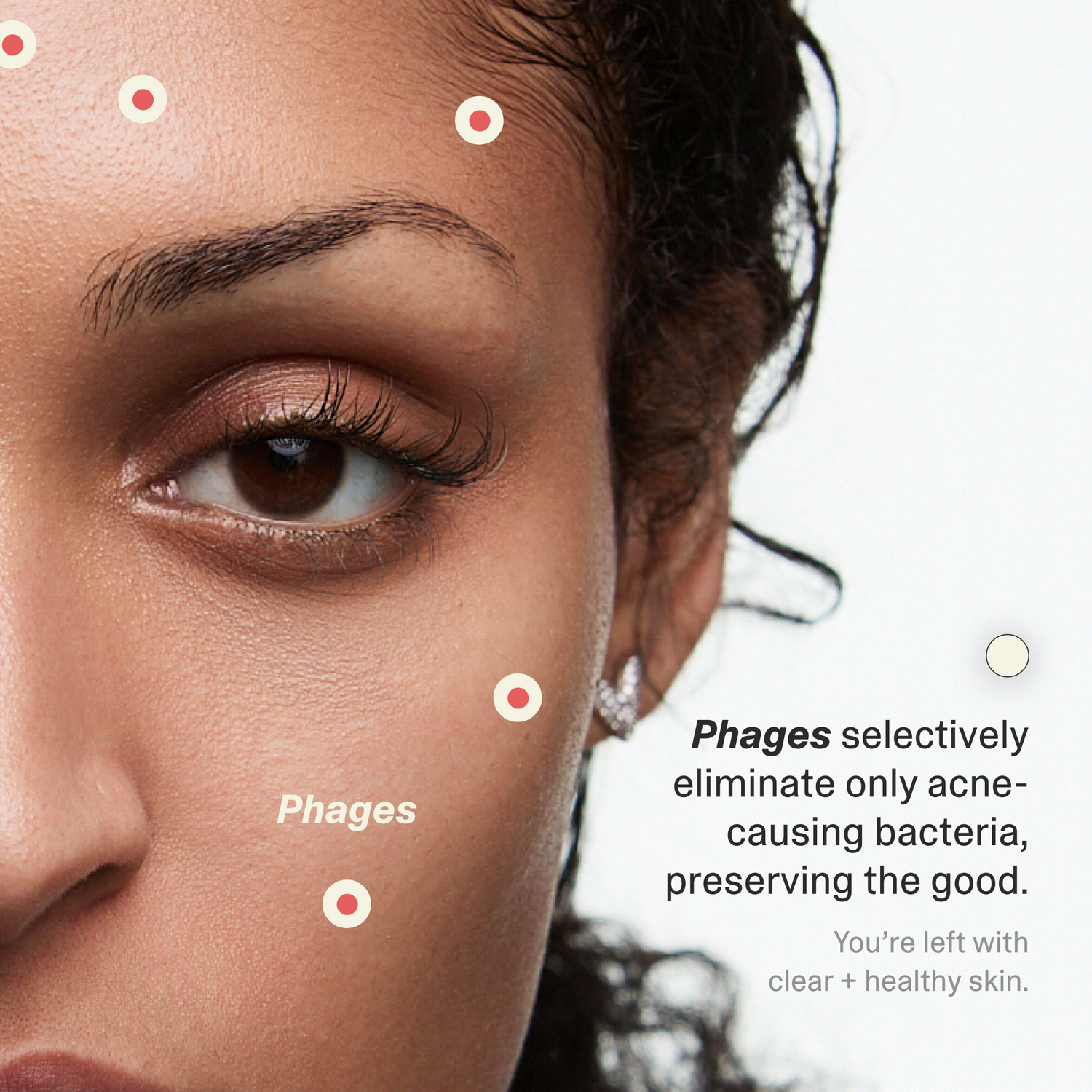 Acne Phage Serum