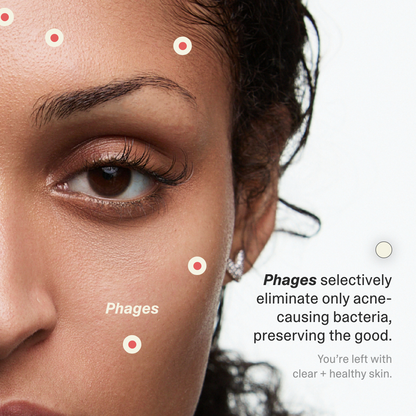 Acne Phage Serum