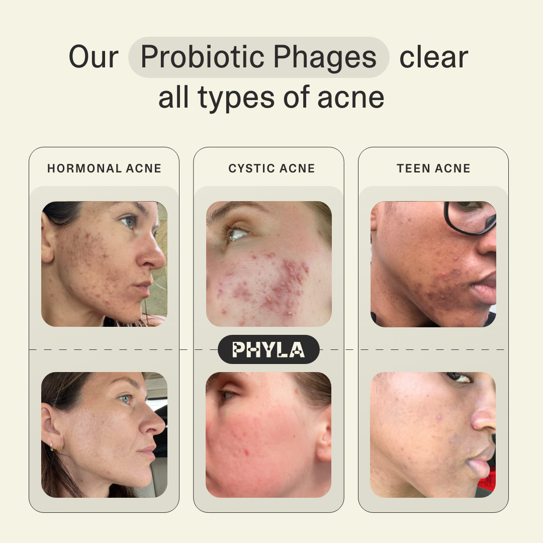 Acne Phage Serum