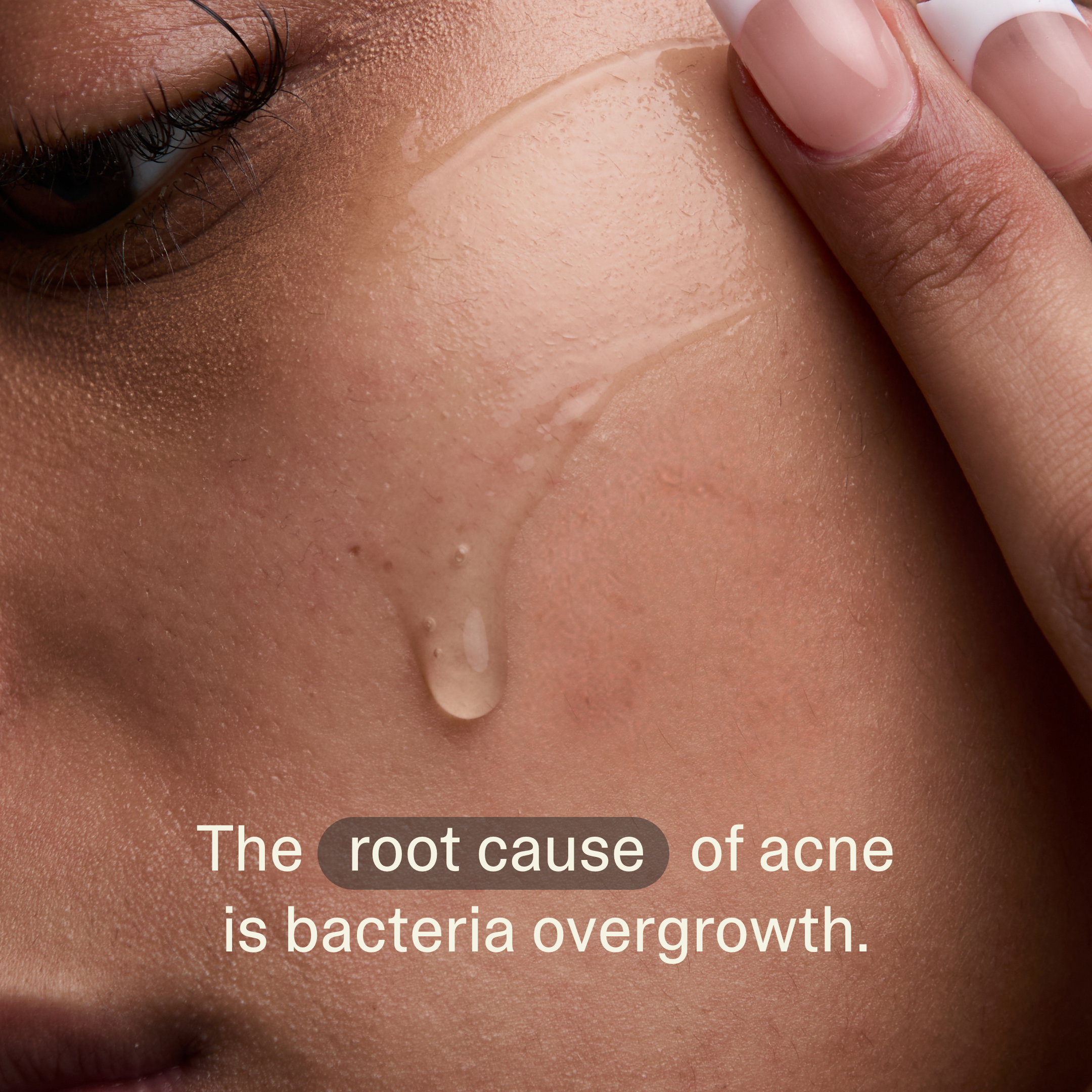 Acne Phage Serum