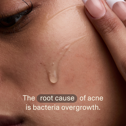 Acne Phage Serum
