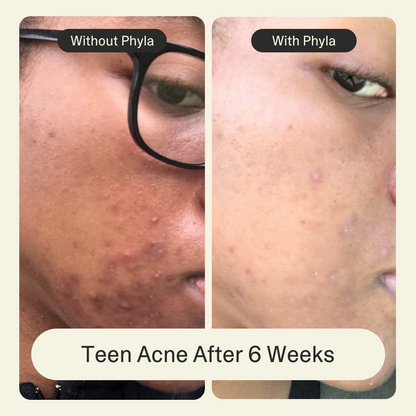 Acne Phage Serum