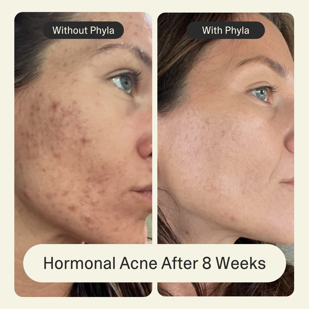 Acne Phage Serum