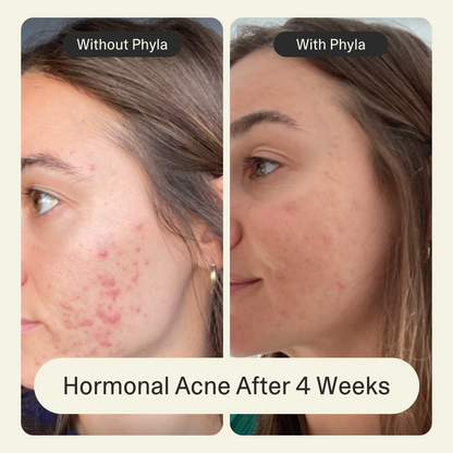 Acne Phage Serum