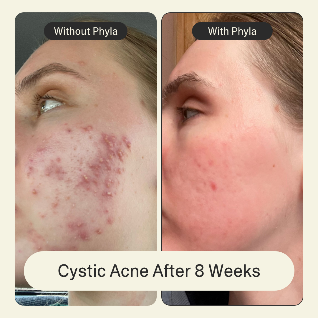 Acne Phage Serum