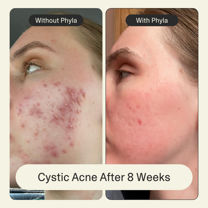 Acne Phage Serum